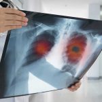 Deadly Fungal Outbreak HIDES in Plain Sight Doctor holding lung Xray with highlighted areas