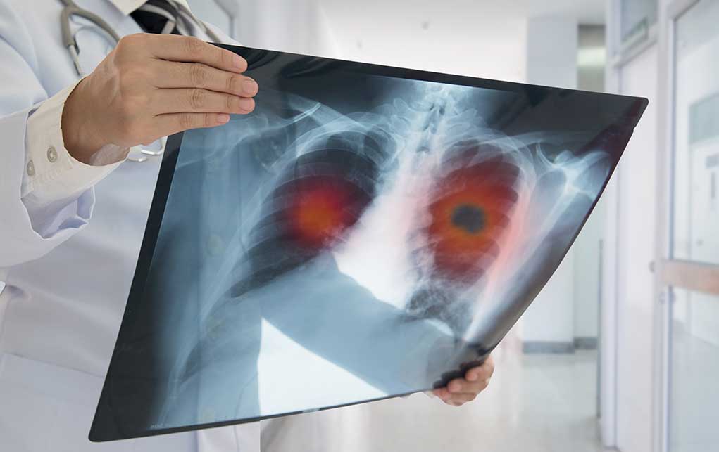 Doctor holding lung Xray with highlighted areas