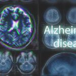 Shocking Grain Link: Dementia Risk Drops Fast MRI brain scan highlighting Alzheimer's disease