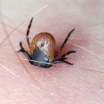 2 Deadly Tick Viruses Are Spreading Across America Tick embedded in human skin