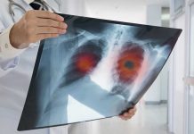Doctor holding lung Xray with highlighted areas
