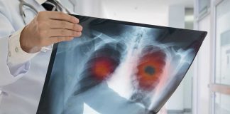 Doctor holding lung Xray with highlighted areas